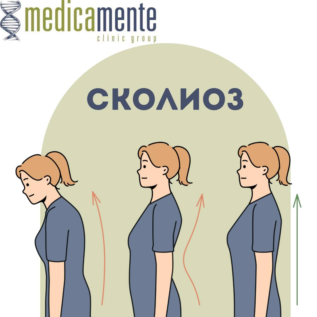 Сколиоз